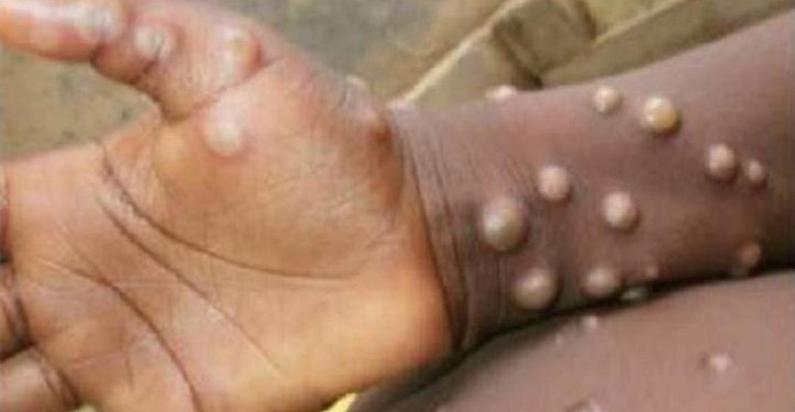 विश्वमा फैलिँदैछ अर्को भाइरस मंकीपक्स, नेपालमा पनि आइपुग्ला ?
