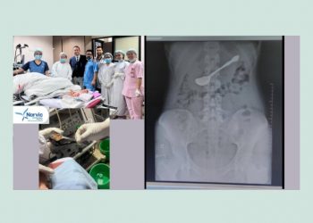 १७ वर्षीया किशोरीको पेटमा चम्चा अड्किएपछि…