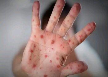 नेपालमा पहिलोपटक मंकीपक्स पुष्टि, साउदी अरेबियाबाट आएका व्यक्तिमा संक्रमण