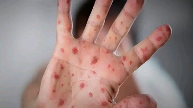 नेपालमा पहिलोपटक मंकीपक्स पुष्टि, साउदी अरेबियाबाट आएका व्यक्तिमा संक्रमण